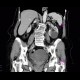 Cystadenoma of ovary: CT - Computed tomography